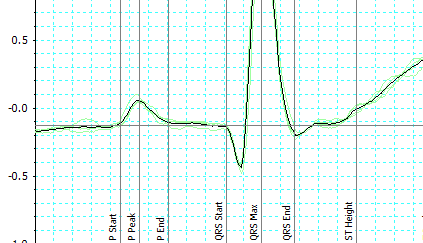 ECG Analysis